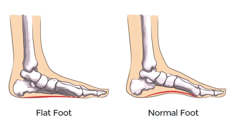 Study extra about Foot deformities – HappyWalk